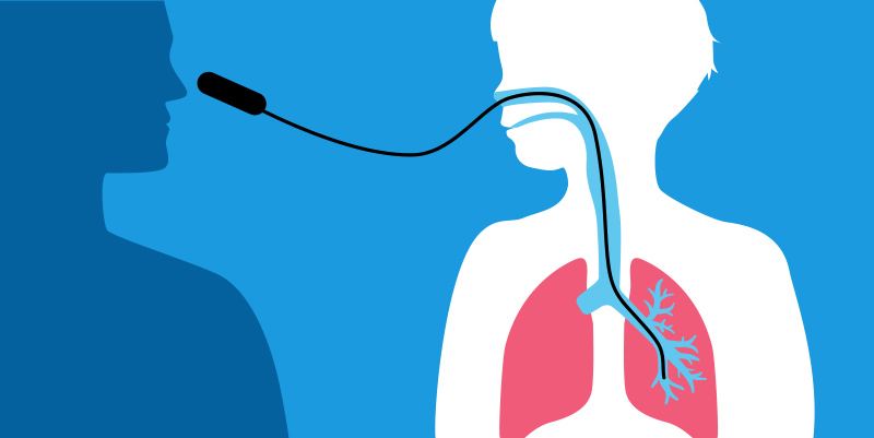 Bronchoscopy - Medical Diagram