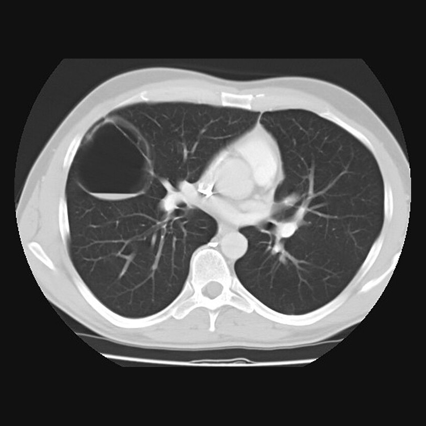Congenital Cystic Scan