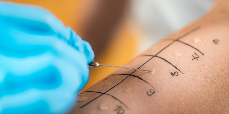 Investigations Skin Prick Allergy Tests