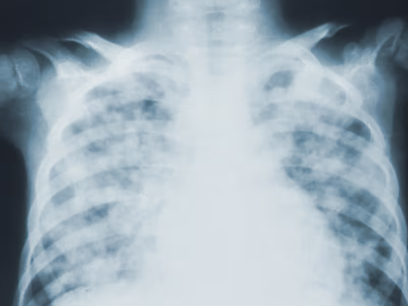 X Ray Of Pneumonia In Child